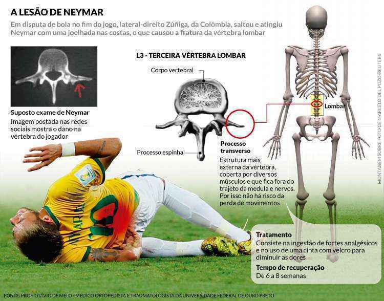 Entenda a lesão que tirou Neymar da fase de grupos da Copa